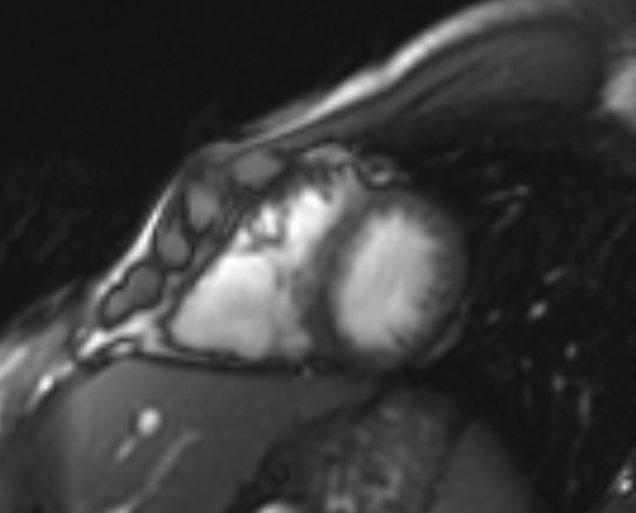 Arrhythmogenic right ventricular cardiomyopathy (Radiopaedia 69564-79464 short axis cine 91).jpg