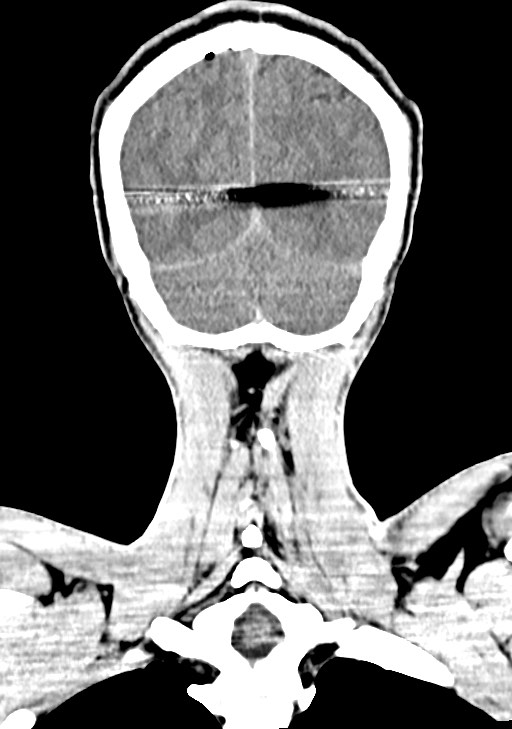 Arrow injury to the brain (Radiopaedia 72101-82607 Coronal non-contrast 60).jpg