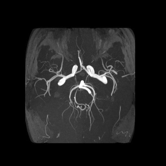 Artery of Percheron infarct (Radiopaedia 40966-43676 F 34).jpg
