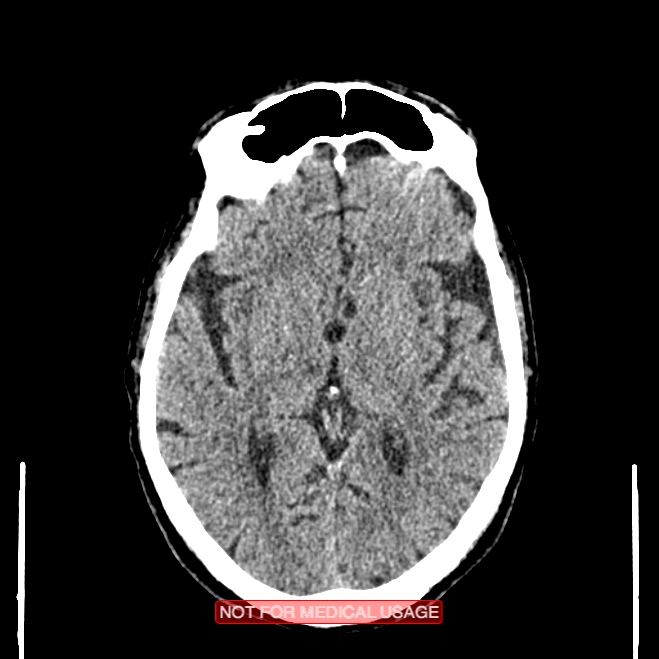 Artery of Percheron infarction (Radiopaedia 28679-28967 Axial non-contrast 60).jpg