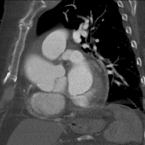 File:Ascending aortic aneurysm (Radiopaedia 20913-20846 A 11).jpg