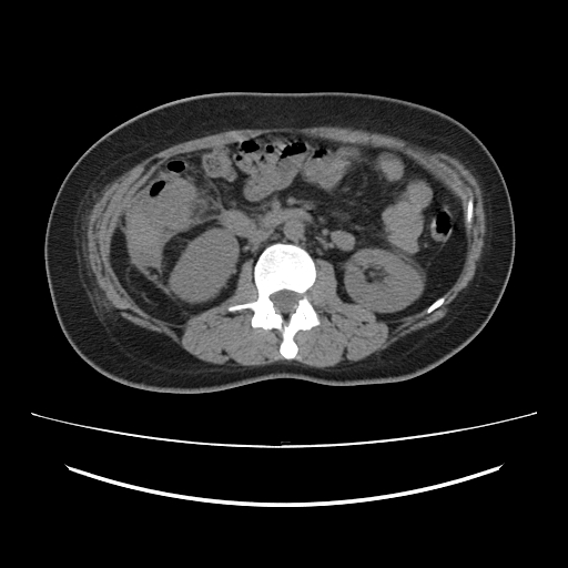 Ascending retrocecal appendicitis with liver abscesses (Radiopaedia 60066-67615 Axial non-contrast 39).jpg