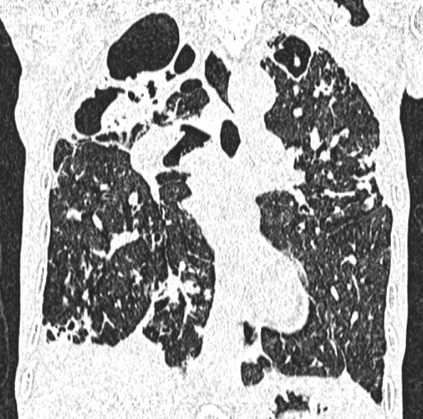 Aspergilloma- with Monod sign (Radiopaedia 44737-48532 Coronal lung window 253).jpg
