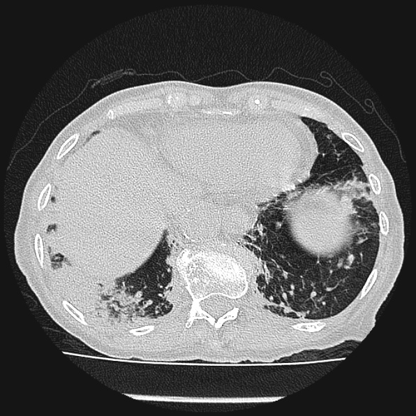 Aspergilloma (Radiopaedia 24458-24763 Axial lung window 57).jpg