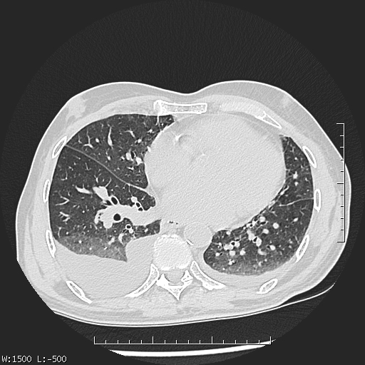 File:Aspergilloma (Radiopaedia 75184-86270 Axial lung window 33).jpg