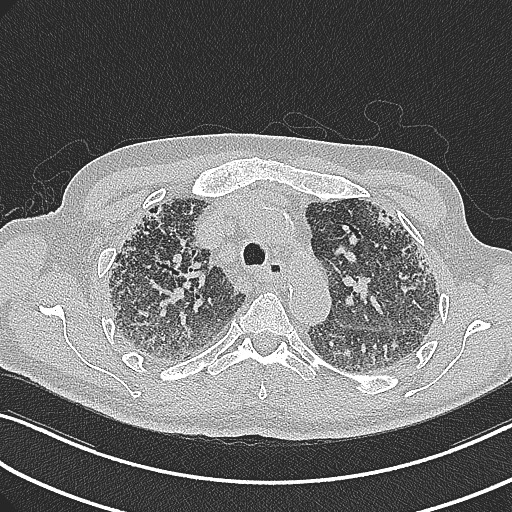 File:Aspergilloma on background pulmonary fibrosis (Radiopaedia 60942-68757 B 18).jpg