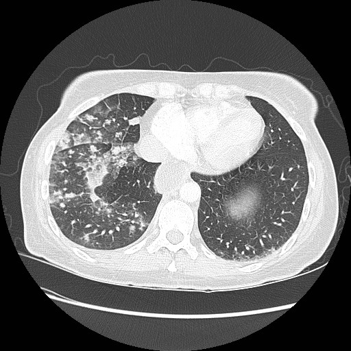 Aspiration pneumonia secondary to laparoscopic banding (Radiopaedia 18345-18183 lung window 85).jpg