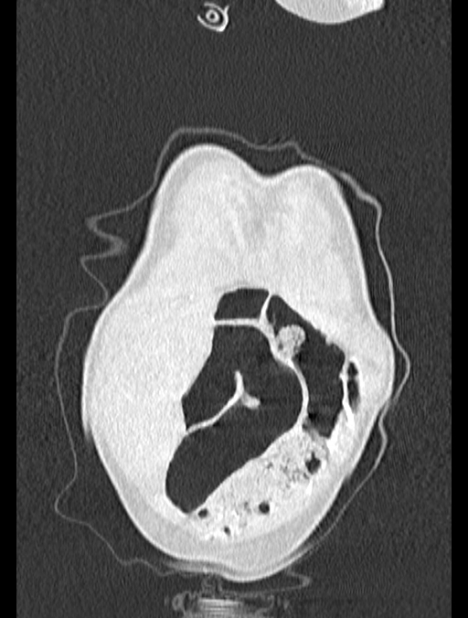 Asplenia syndrome (Radiopaedia 73083-83792 Coronal lung window 2).jpg