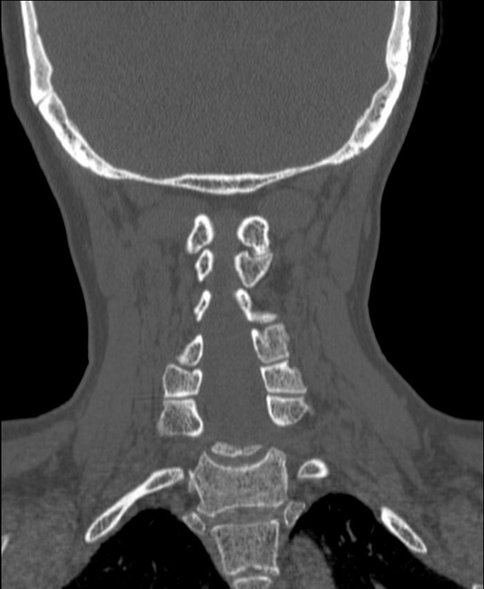 Atlanto-occipital assimilation with basilar invagination (Radiopaedia 70122-80188 Coronal bone window 152).jpg