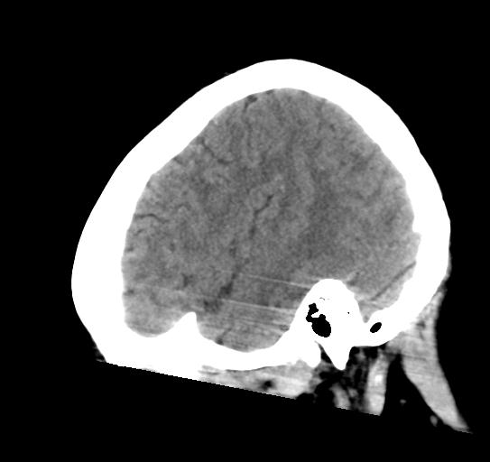 File:Atretic encephalocoele with inferior vermis hypoplasia (Radiopaedia 30443-31107 C 7).jpg