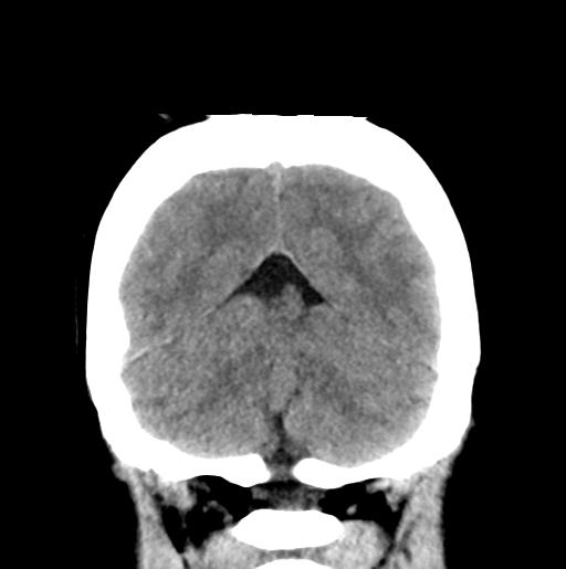 File:Atretic encephalocoele with inferior vermis hypoplasia (Radiopaedia 30443-31107 Coronal non-contrast 31).jpg