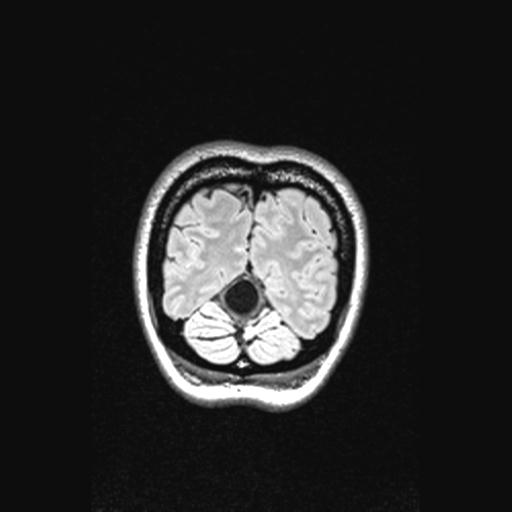 Atretic encephalocoele with inferior vermis hypoplasia (Radiopaedia 30443-31108 Coronal FLAIR 29).jpg