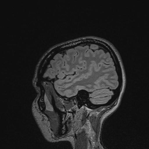 Atretic encephalocoele with inferior vermis hypoplasia (Radiopaedia 30443-31108 Sagittal FLAIR 124).jpg