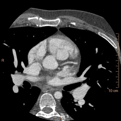 Atrial septal defect (upper sinus venosus type) with partial anomalous pulmonary venous return into superior vena cava (Radiopaedia 73228-83961 A 93).jpg