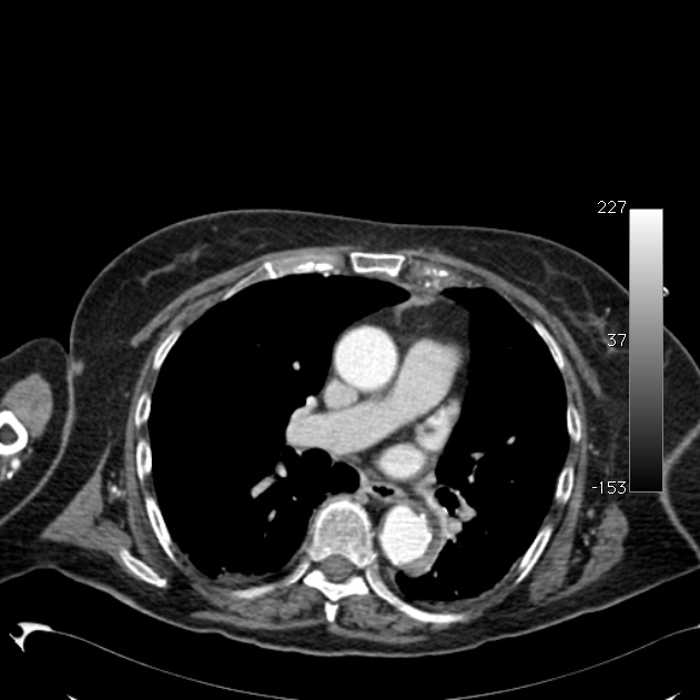 Atypical dissection of the thoracic aorta (Radiopaedia 10975-11393 A 35).jpg