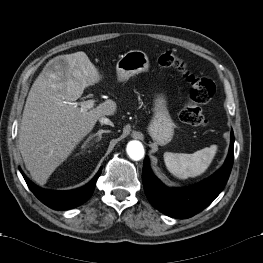 Atypical hepatocellular carcinoma (Radiopaedia 41744-44698 A 25).jpg