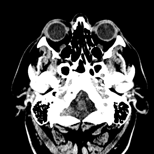 File:Atypical meningioma (WHO grade II) with brain invasion (Radiopaedia 57767-64728 Axial non-contrast 2).png