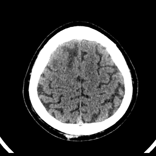 File:Atypical meningioma (WHO grade II) with brain invasion (Radiopaedia 57767-64728 Axial non-contrast 37).png