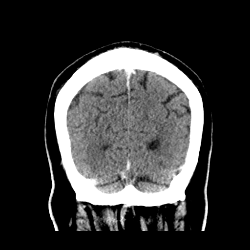 Atypical meningioma (WHO grade II) with brain invasion (Radiopaedia 57767-64728 Coronal C+ 53).png