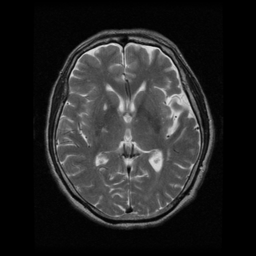 File:Atypical meningioma (WHO grade II) with osseous invasion (Radiopaedia 53654-59716 Axial T2 11).png