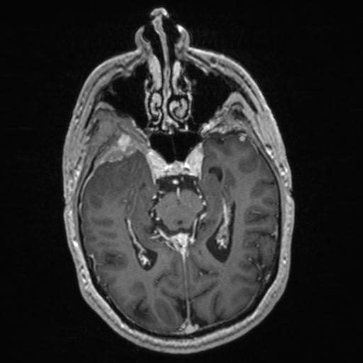Atypical meningioma (grade II) - en plaque (Radiopaedia 29633-30147 Axial T1 C+ 79).jpg