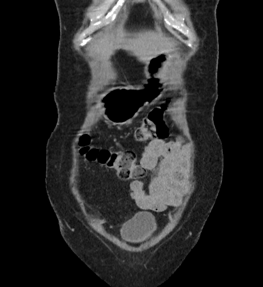 Autosomal dominant polycystic kidney disease (Radiopaedia 38189-40194 Coronal C+ delayed 1).jpg