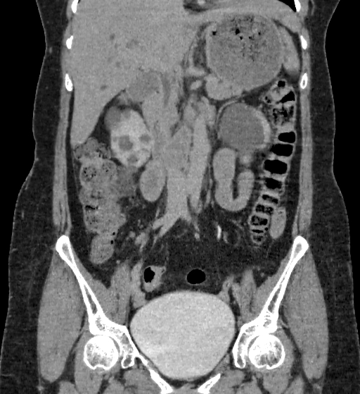 Autosomal dominant polycystic kidney disease (Radiopaedia 38189-40194 Coronal C+ delayed 37).jpg
