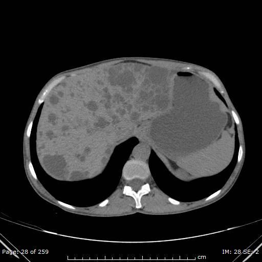 Autosomal dominant polycystic kidney disease (Radiopaedia 44122-47684 Axial non-contrast 10).jpg