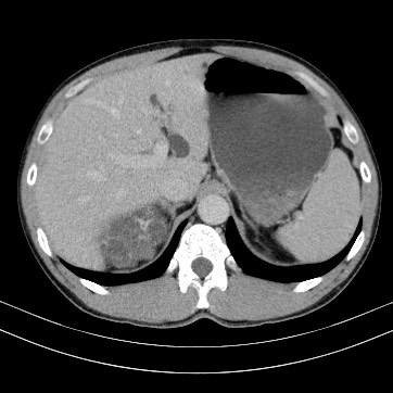 Autosomal dominant polycystic kidney disease (Radiopaedia 66349-75582 B 19).jpg