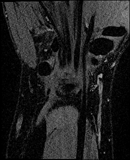 Avascular necrosis of the capitate (Radiopaedia 88317-104948 Coronal T1 vibe 61).jpg