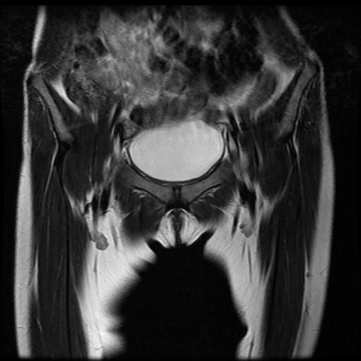 File:Avascular necrosis of the hip (Radiopaedia 29563-30067 Coronal T2 1).jpg
