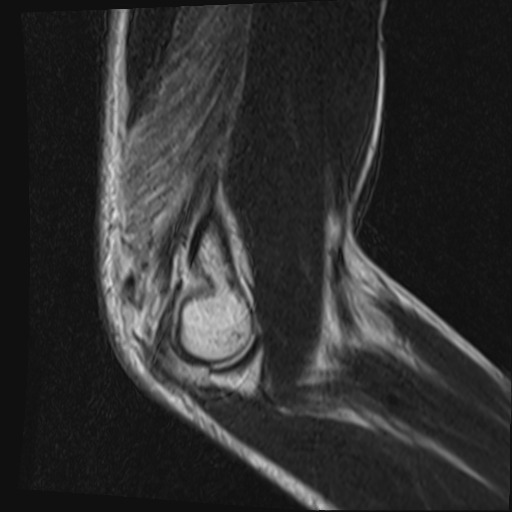 File:Avulsion of the triceps tendon (Radiopaedia 42919-46154 Sagittal T2 7).jpg