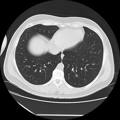 Azygos fissure (Radiopaedia 88181-104784 Axial lung window 39).jpg