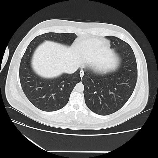 Azygos fissure (Radiopaedia 88181-104784 Axial lung window 41).jpg