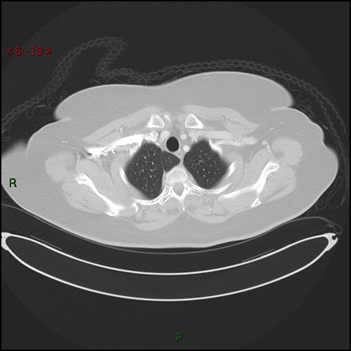 Azygos fissure and lobe (Radiopaedia 47620-52278 Axial lung window 13).jpg