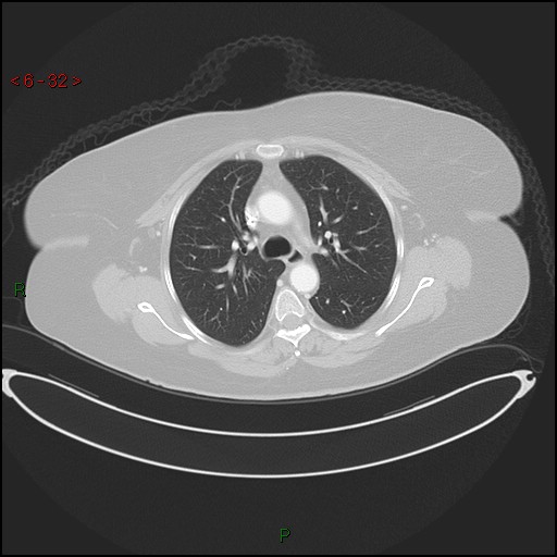 Azygos fissure and lobe (Radiopaedia 47620-52278 Axial lung window 32).jpg
