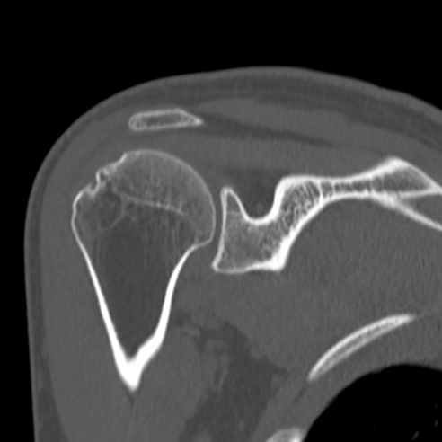 Bankart lesion (Radiopaedia 57256-64185 Coronal bone window 28).jpg