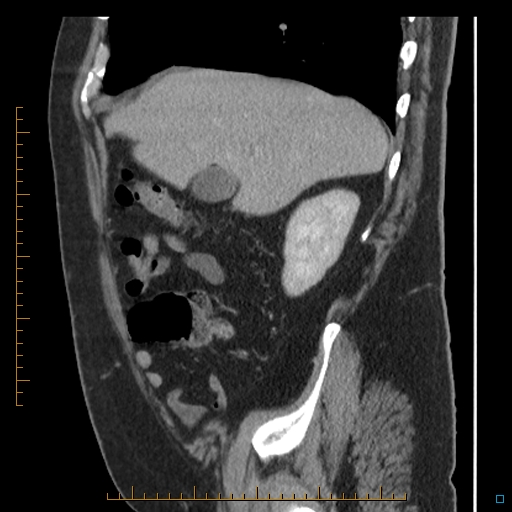 File:Bariatric balloon causing gastric outlet obstruction (Radiopaedia 54449-60672 C 62).jpg