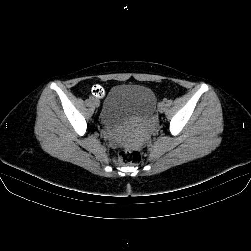 Bartholin gland cyst (Radiopaedia 62635-70930 Axial non-contrast 46).jpg