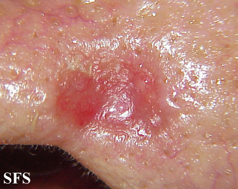 Basal Cell Carcinoma (Dermatology Atlas 108).jpg