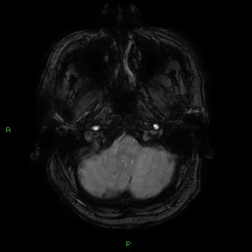 Basal ganglia hemorrhage (Radiopaedia 58346-65468 Axial SWI 8).jpg