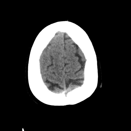 Basal ganglia metastasis (Radiopaedia 78928-91830 Axial non-contrast 52).png
