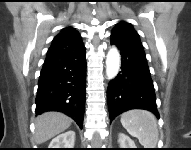 Basal ganglia metastasis (Radiopaedia 78928-91832 C 39).png
