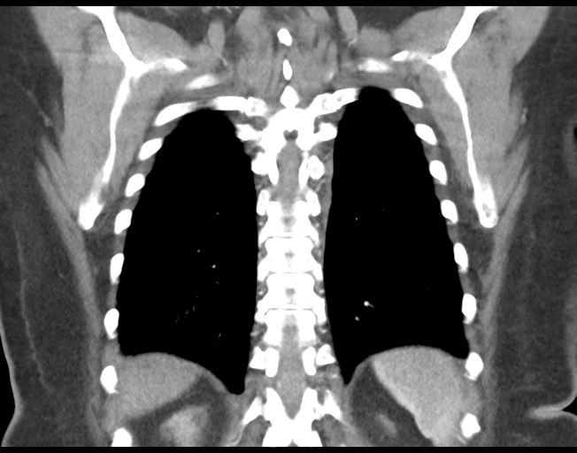 Basal ganglia metastasis (Radiopaedia 78928-91832 C 41).png