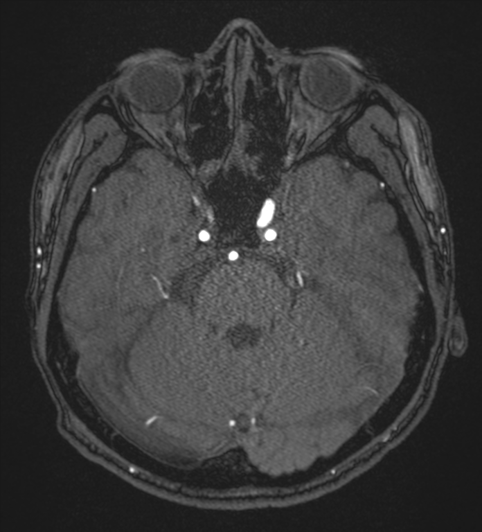 Basal ganglia subacute infarct (Radiopaedia 80201-93521 Axial MRA 31).png