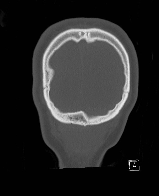 Base of skull fracture with bilateral Le Fort fractures (Radiopaedia 47094-51638 Coronal bone window 9).jpg