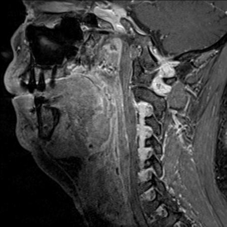 File:Base of tongue squamous cell carcinoma (Radiopaedia 31174-31884 F 69).jpg