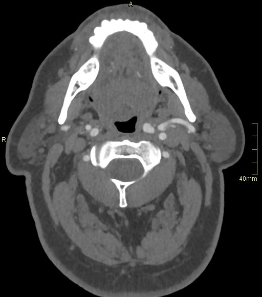 File:Basilar artery aneurysm (Radiopaedia 56261-62932 A 18).jpg