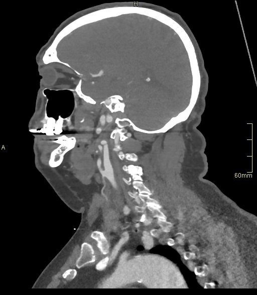 Basilar artery aneurysm (Radiopaedia 56261-62932 C 48).jpg