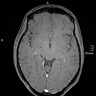 Basilar artery perforator aneurysm (Radiopaedia 82455-99523 G 69).jpg